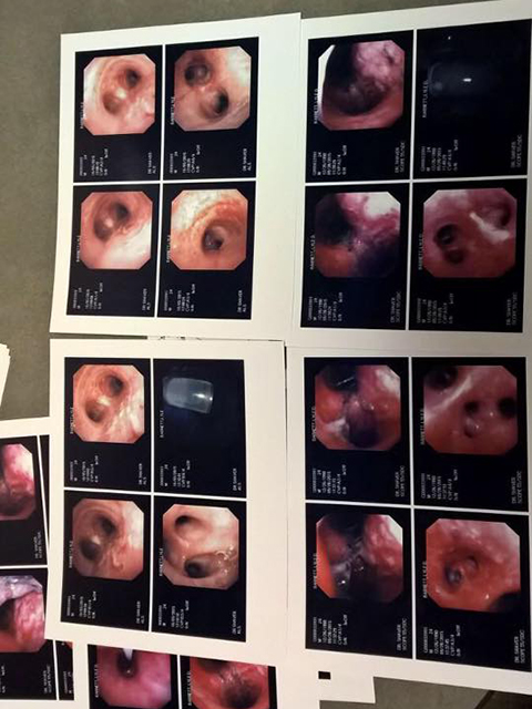 Endoscope photos of Lyle's lungs. On the left, his healthy lungs following his week-long bronchial treatments. On the right, his damaged lungs immediately following the crash.